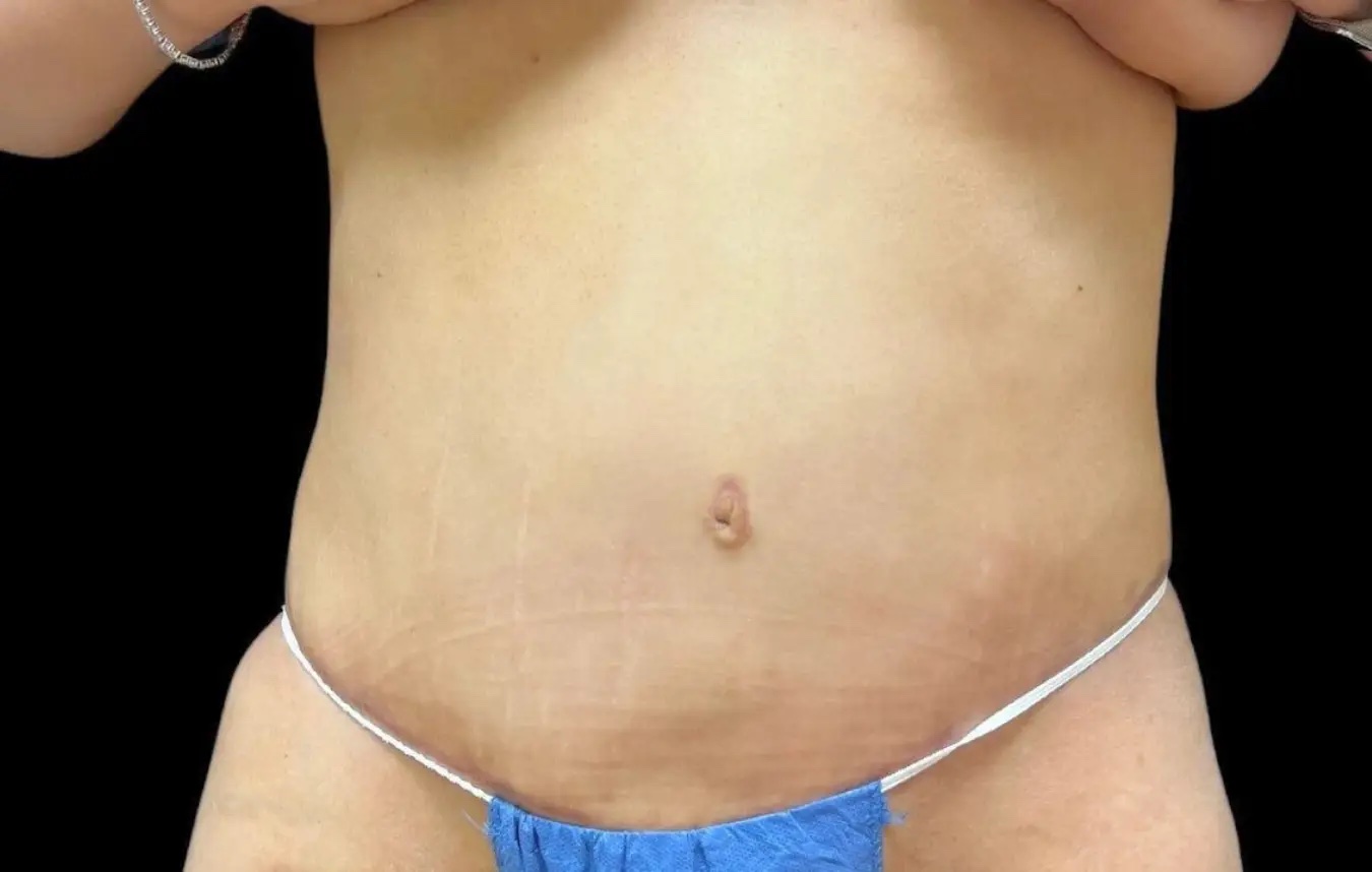 Tummy tuck patient after surgery, abdomen, front view
