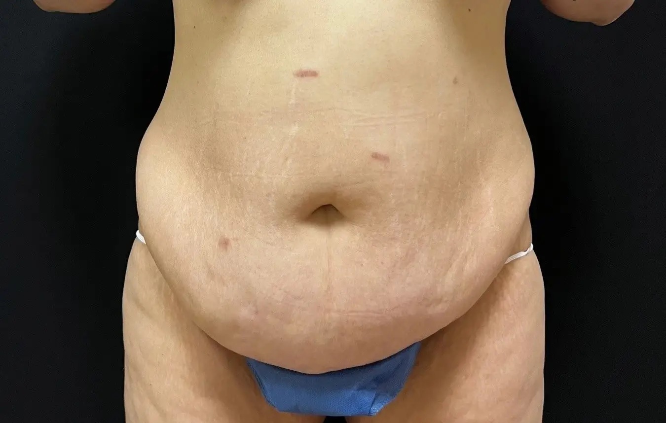 Tummy tuck patient before surgery, abdomen, front view