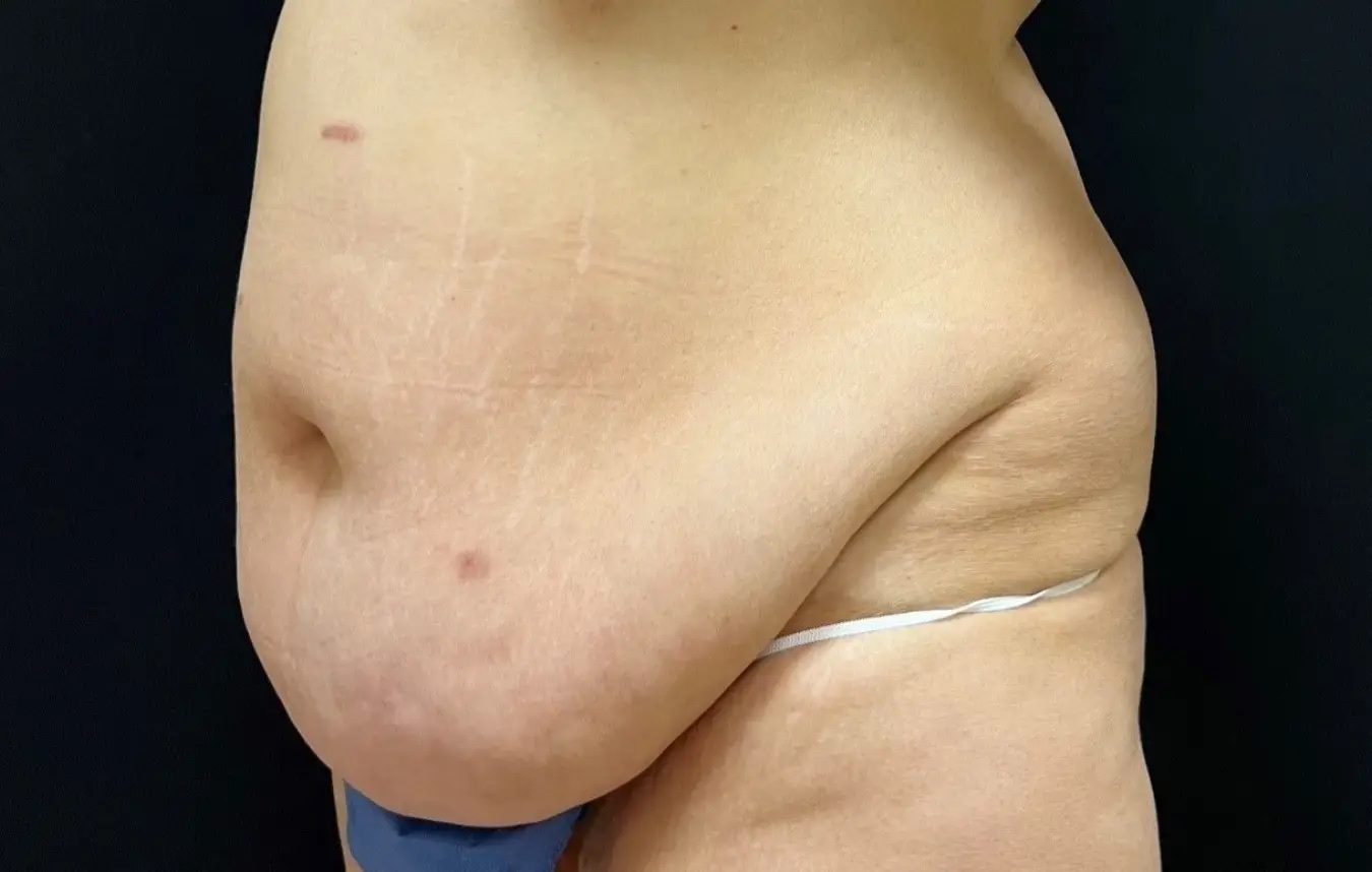 Tummy tuck patient before surgery, abdomen, three-quarter view