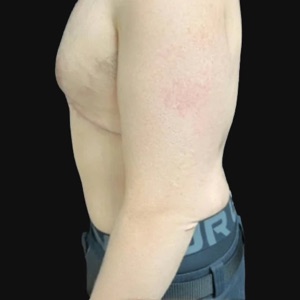 Side view of the torso after body contouring