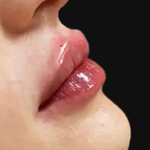 Lips in profile after lip filler