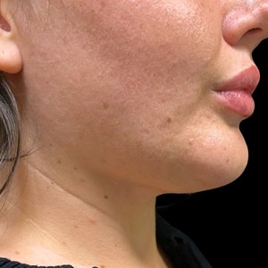 Jawline and neck in profile after treatment
