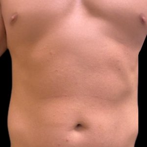 Male chest and abdomen before body contouring