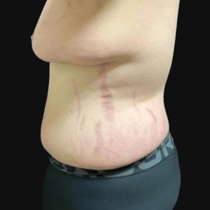 Side view of the torso before body contouring