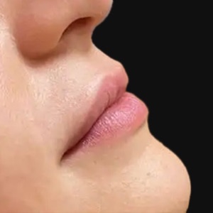 Lips in profile before lip filler