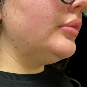 Jawline and neck in profile before treatment