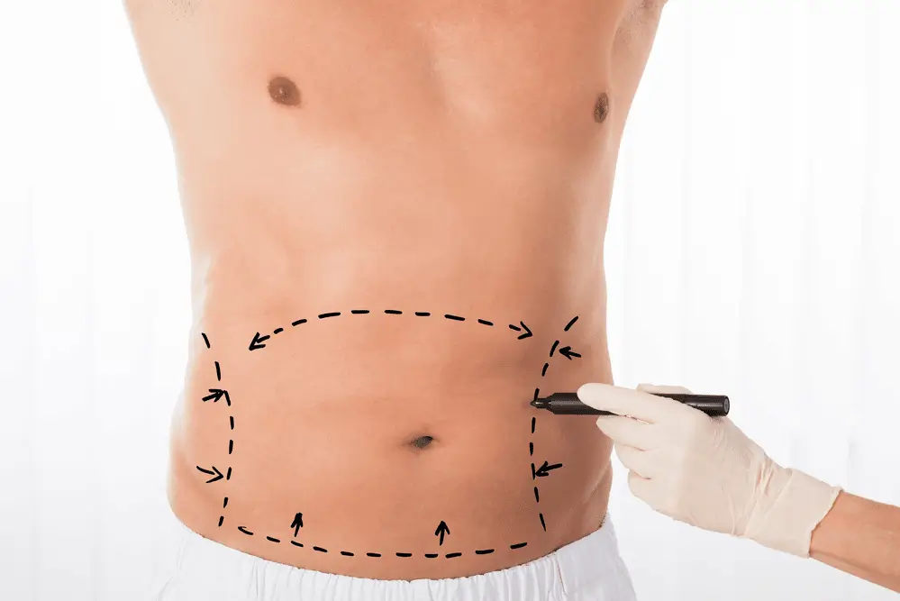 A hand wearing a surgical glove holds a marker and draws a dashed line with arrows around a man's lower abdomen, indicating the area for a surgical procedure.
