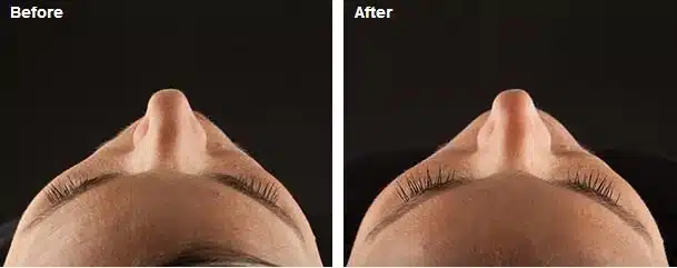 Juvederm before & after results.