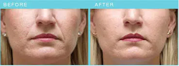 Radiesse before & after results.