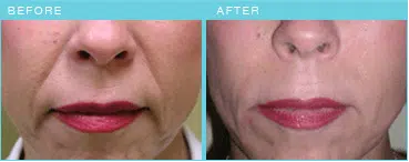 Radiesse before & after results.
