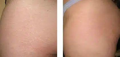 Patient before & after results.