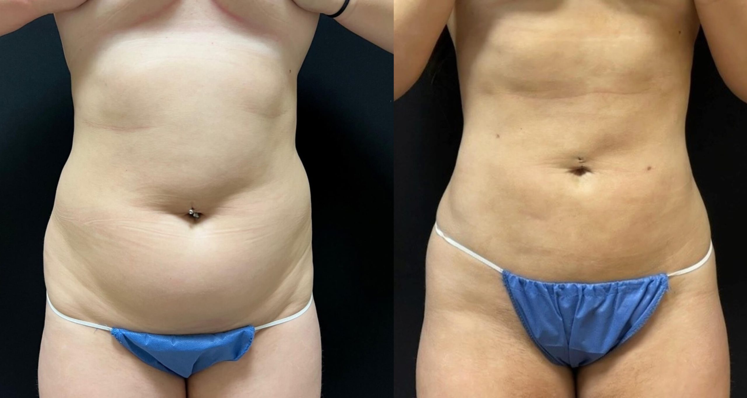 Smartlipo patient before & after results.