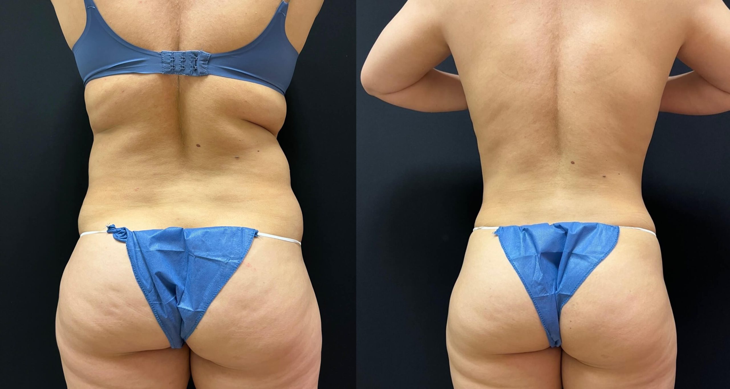 Smartlipo patient before & after results.