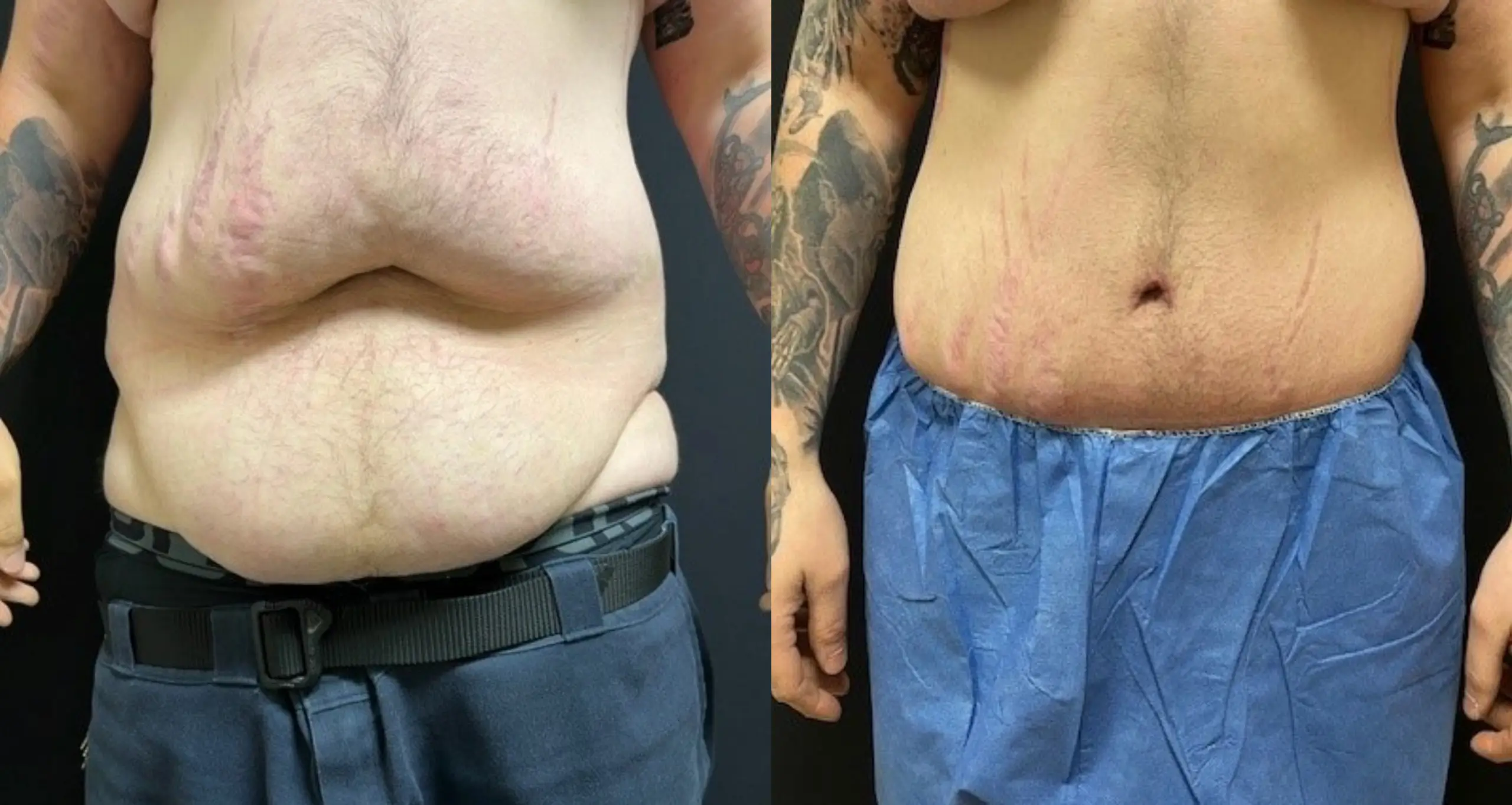 Tummy tuck patient before & after results.