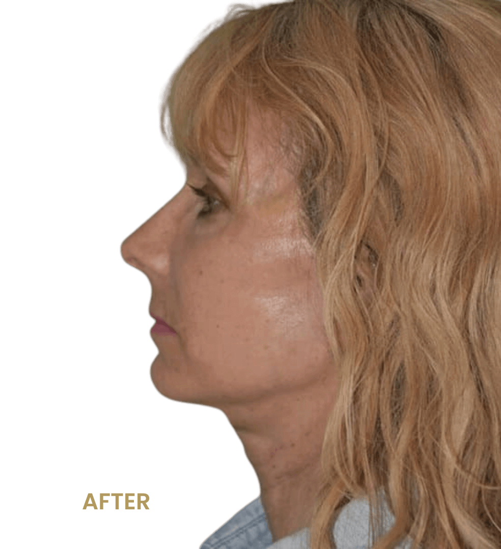 Botox patient before & after results.