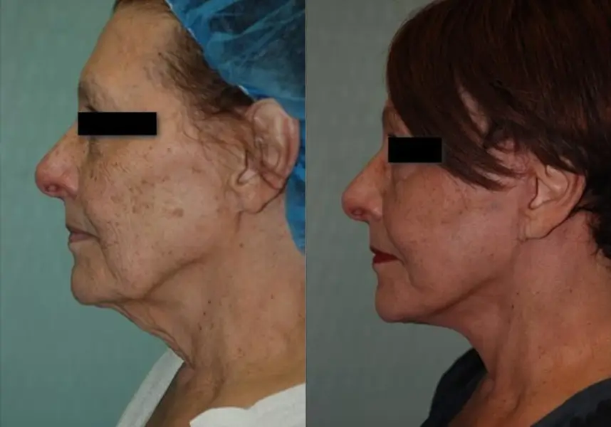 Before and after profile images of a female patient showing the effects of a cosmetic procedure. The left side displays the patient's profile before treatment, highlighting signs of aging such as sagging skin and wrinkles. The right side presents the same patient post-treatment, showcasing a smoother jawline and improved skin tightness, illustrating the positive results of the procedure. Both images are taken under similar lighting conditions for accurate comparison.