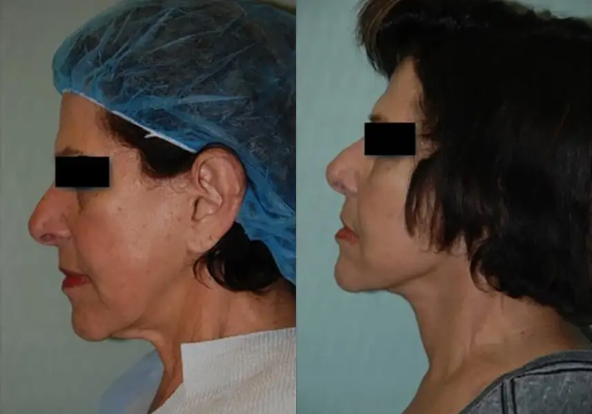 Before and after profile images of a woman showcasing the results of a cosmetic procedure. The left side displays her features prior to the treatment, including visible signs of aging, while the right side illustrates a smoother jawline and enhanced facial contours post-procedure. The woman is wearing a surgical cap on the left, highlighting a clinical setting. These images emphasize the transformation achievable through cosmetic enhancements, aimed at rejuvenating appearance and boosting confidence.