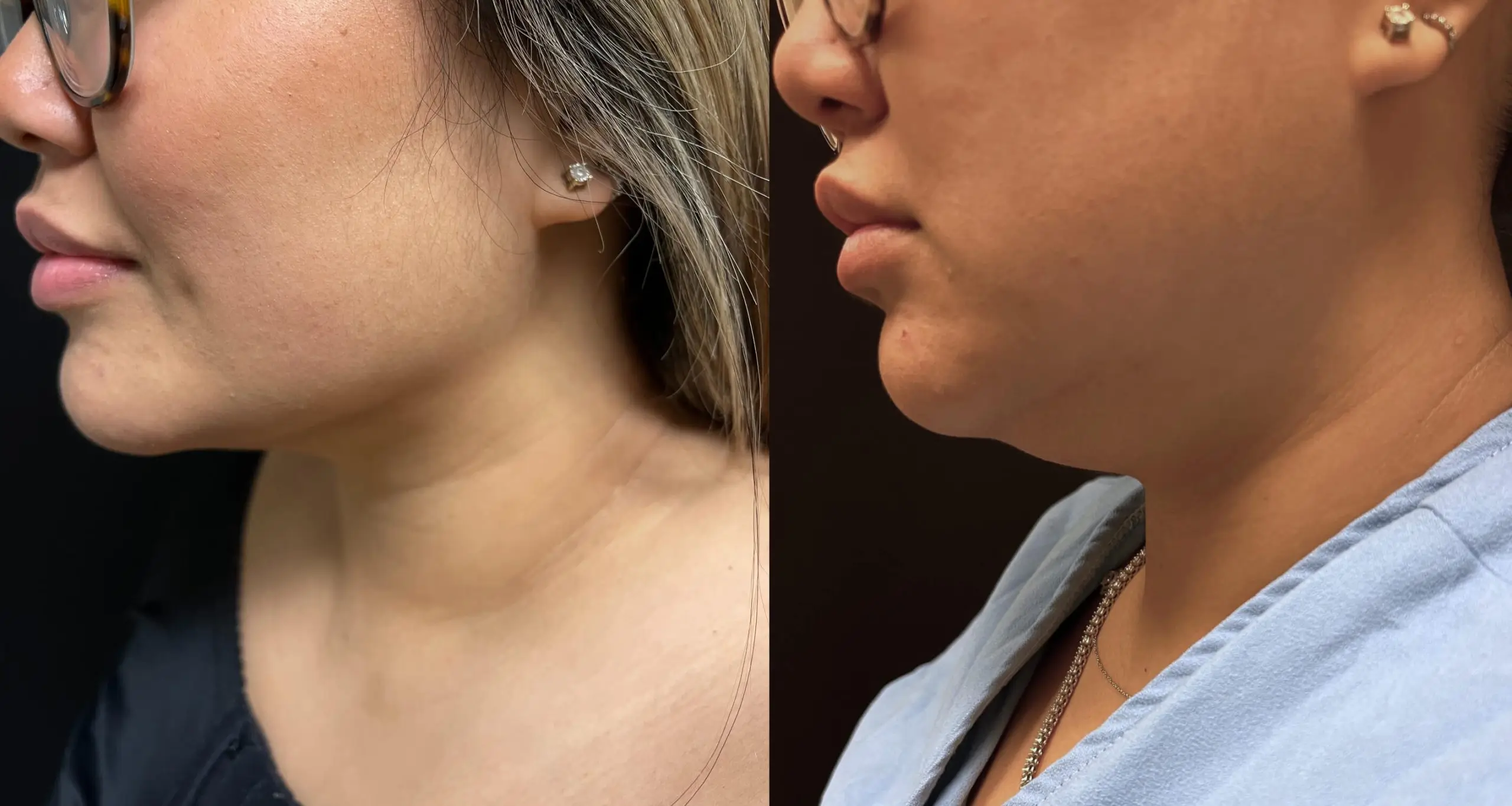 Side-by-side close-up profile views of two women, one in a black top and the other in a blue top, focusing on their neck and jawline areas.