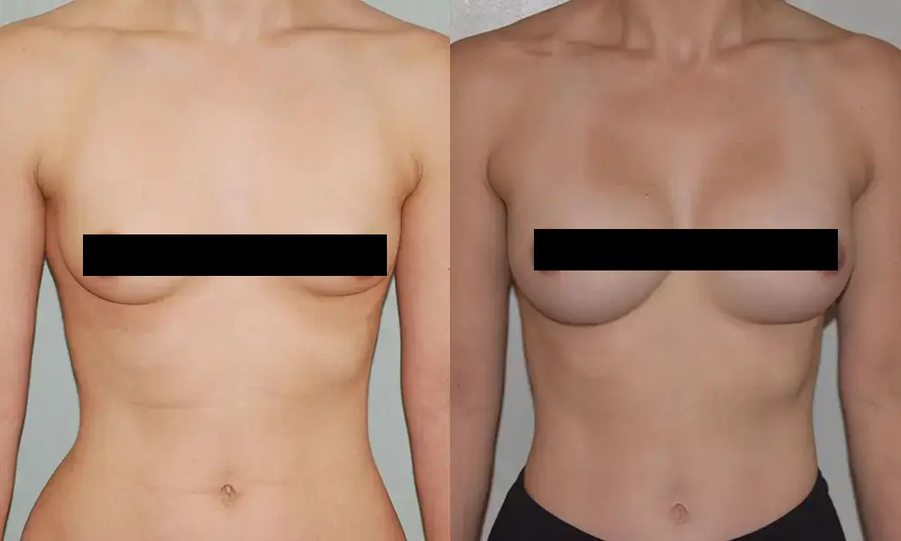 breast-augmentation-2804 CENSORED