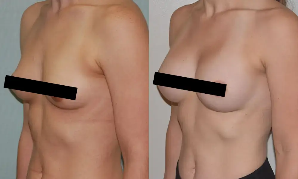 breast-augmentation-2805 CENSORED