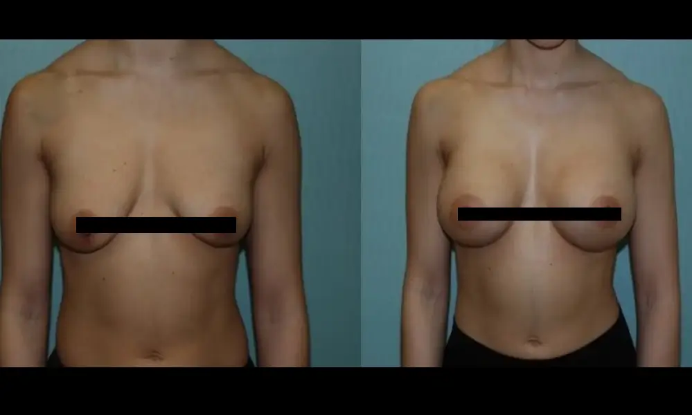 breast-augmentation-1-CENSORED