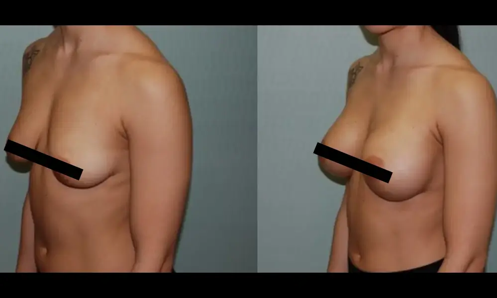 breast-augmentation-2-CENSORED