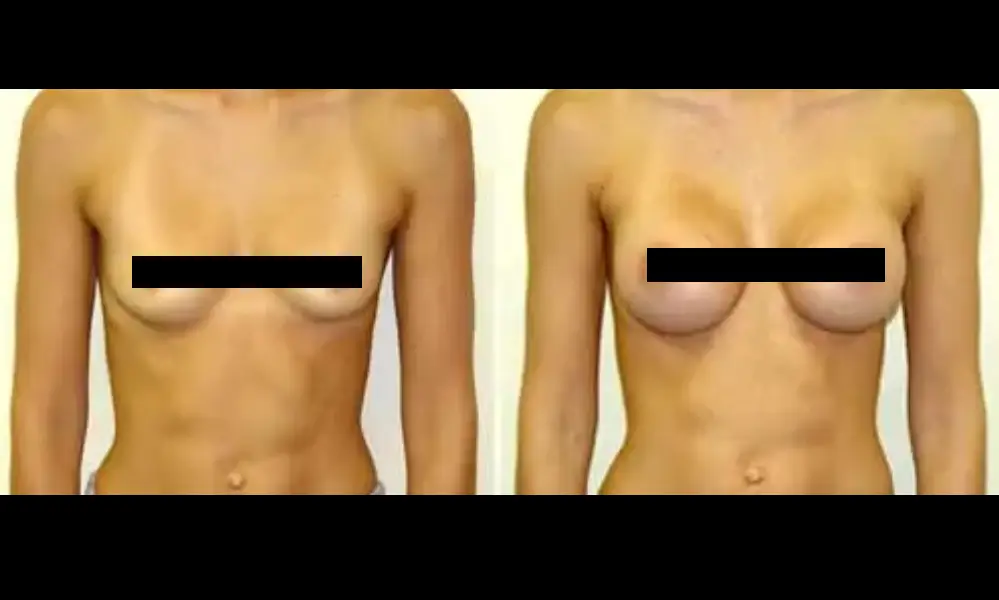 breast-augmentation-3-CENSORED