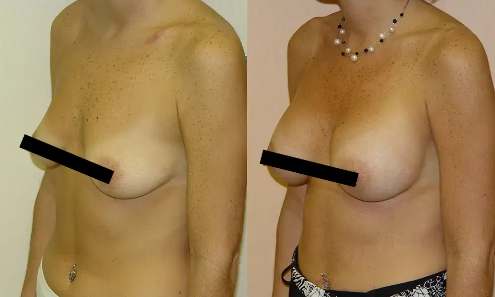 breast-augmentation-4-CENSORED