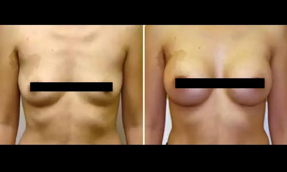 breast-augmentation-5-CENSORED