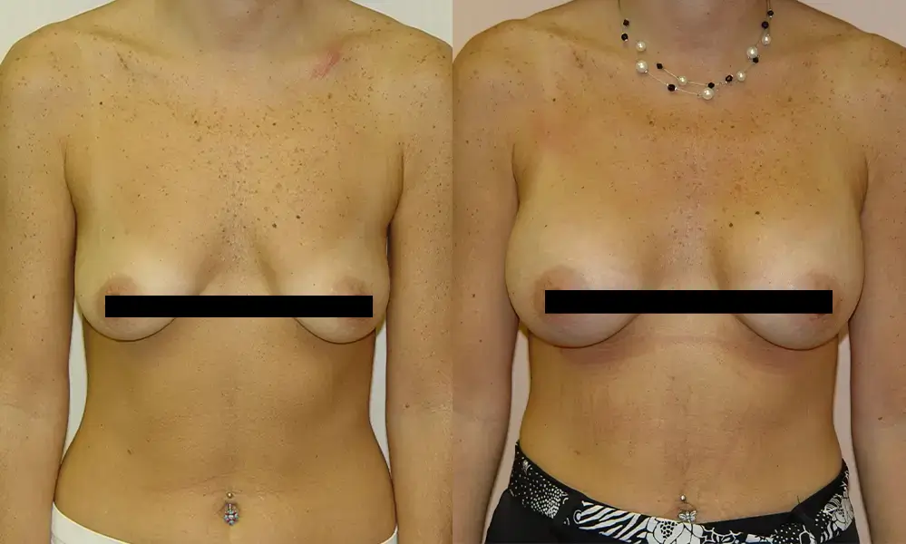 breast-augmentation-6-CENSORED