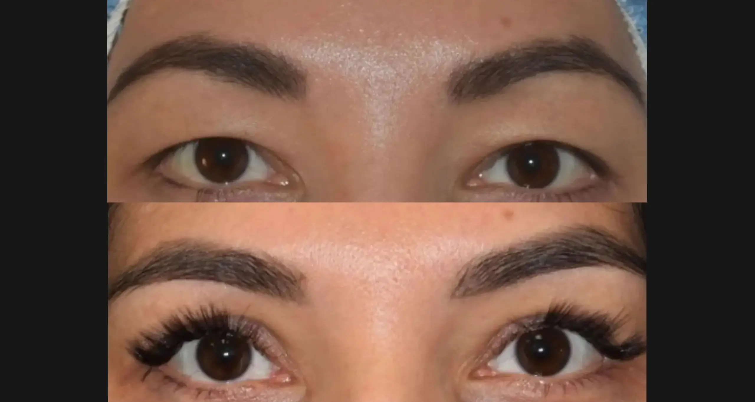 Blepharoplasty 1