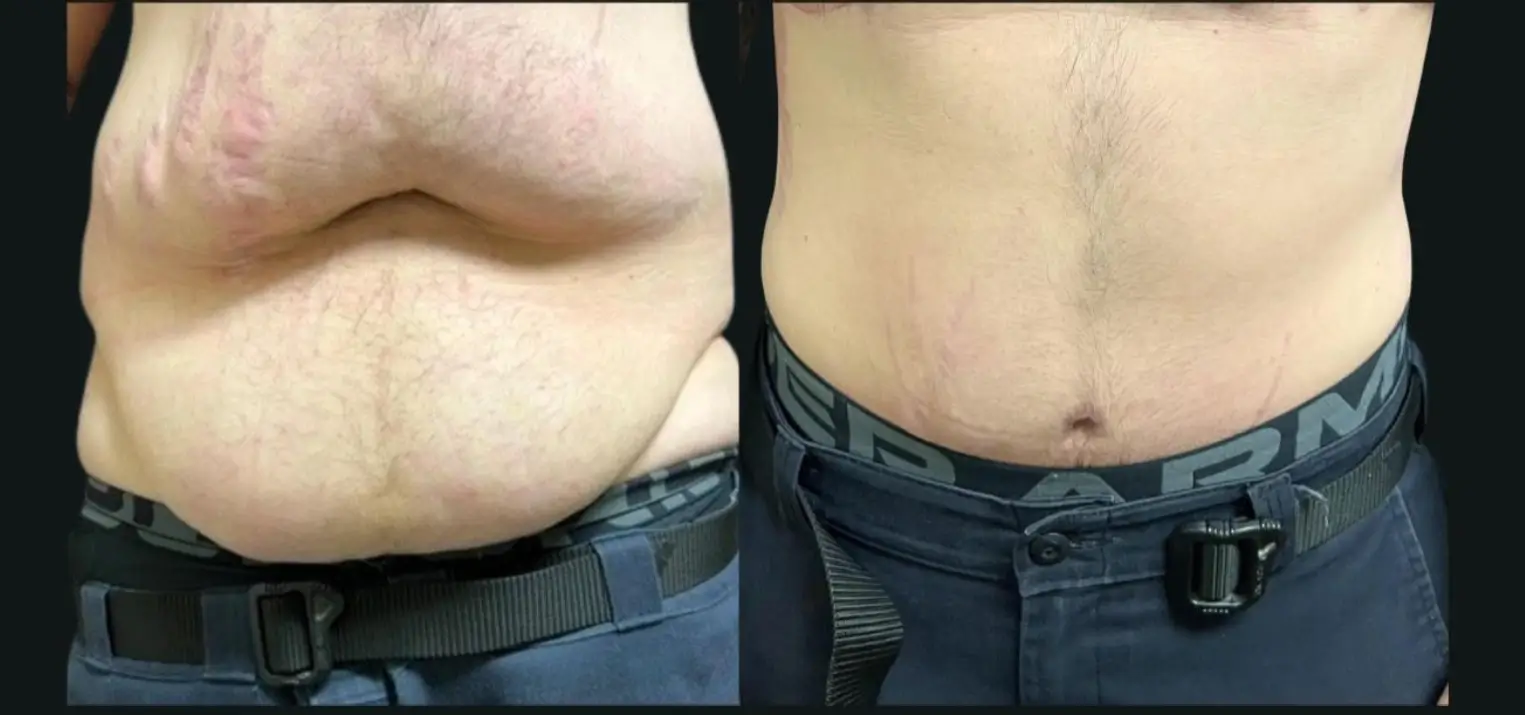 Skin-removal-1