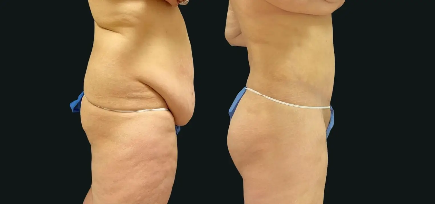 Skin-removal-2