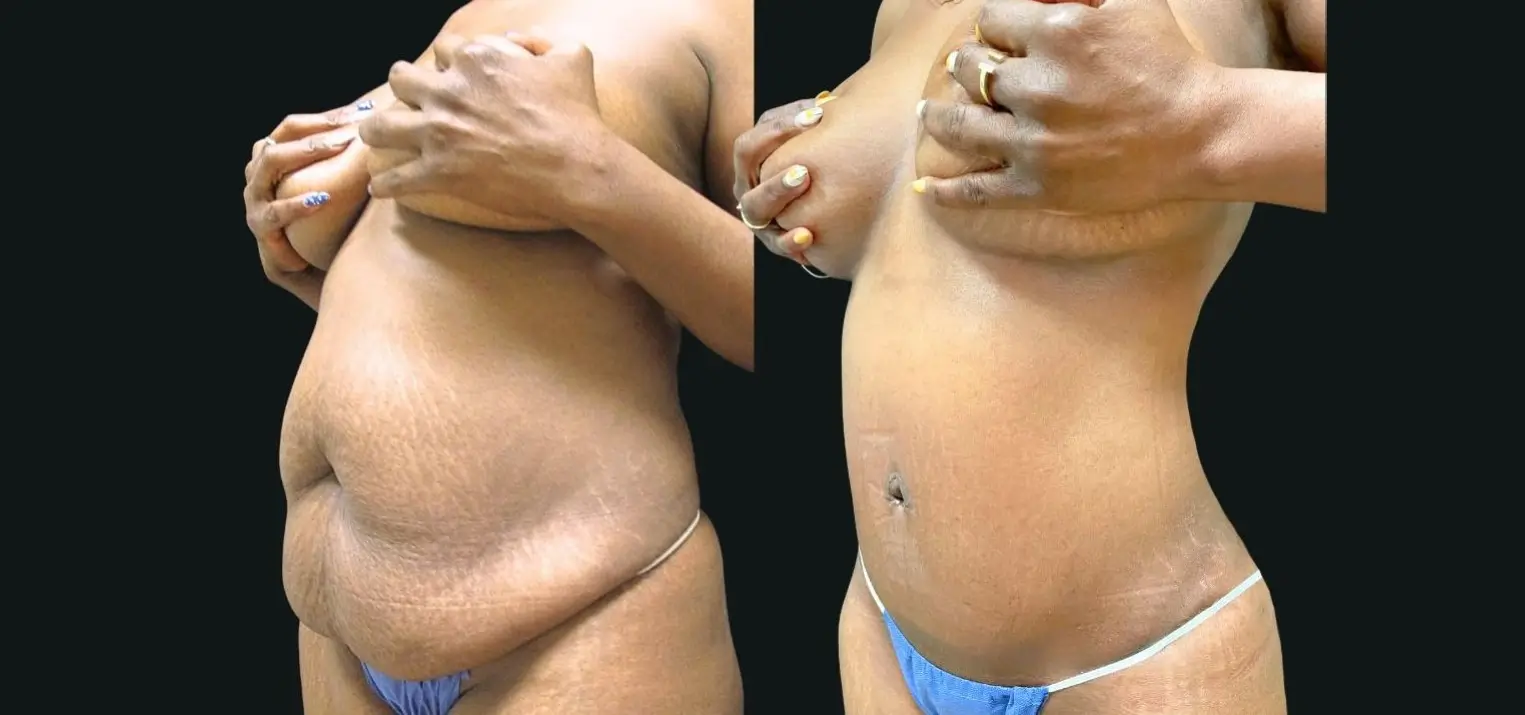 Skin-removal-3