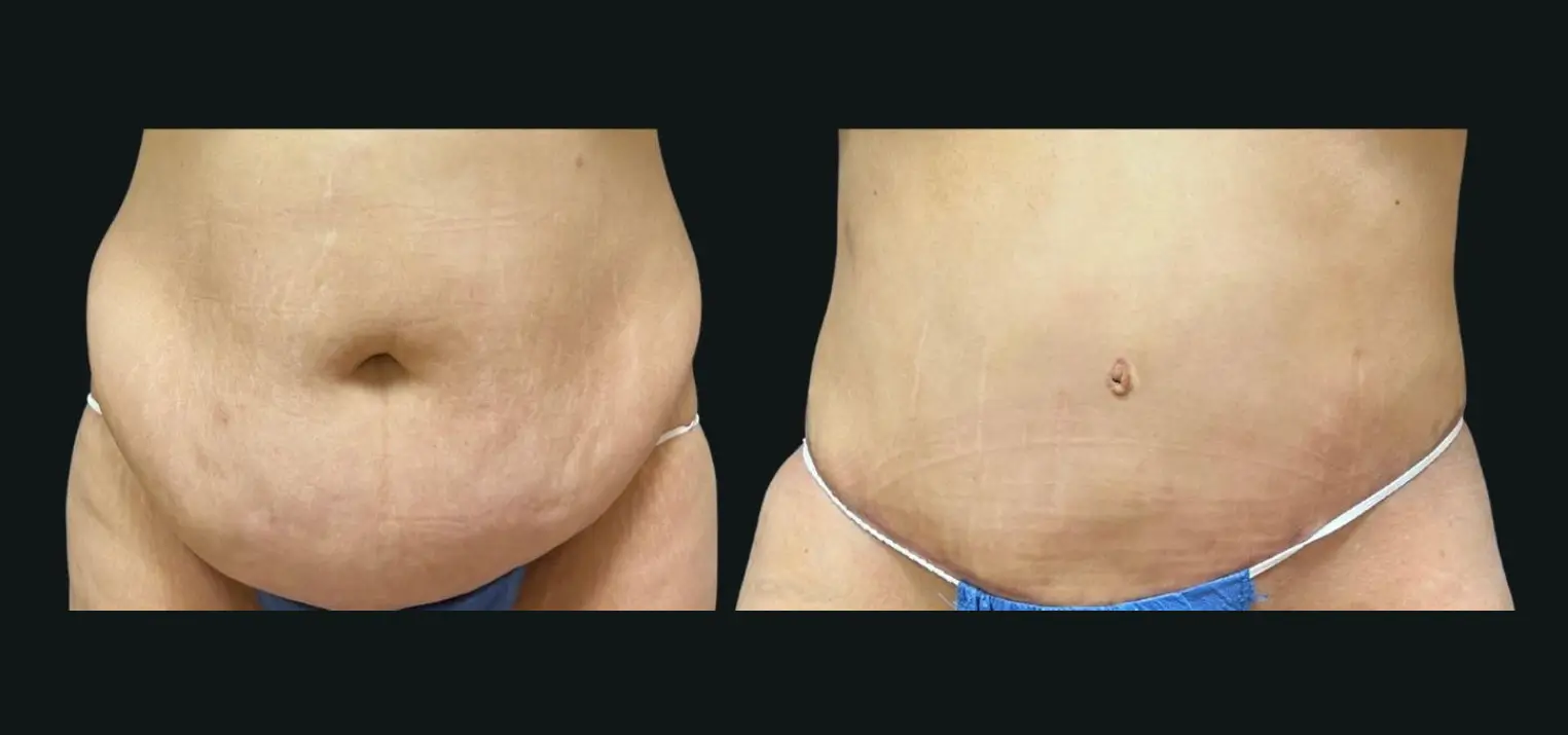 Skin-removal-5