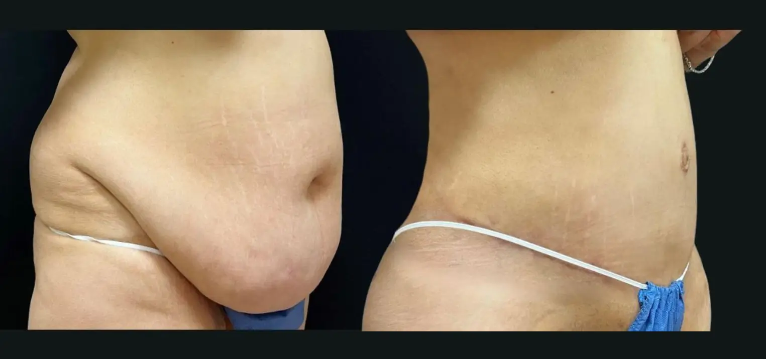 Skin-removal-6