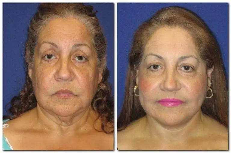 Before and after images showcasing the effects of facial rejuvenation treatments. The left side displays a woman with visible signs of aging, including wrinkles and sagging skin. The right side illustrates the enhanced appearance following the treatment, featuring smoother skin, reduced wrinkles, and a more youthful look. This transformation highlights the potential benefits of cosmetic procedures for facial revitalization, emphasizing improved skin texture and overall facial aesthetics.