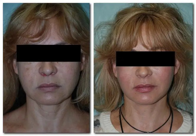 Before and after images of a female patient showcasing facial rejuvenation results. The left image displays the patient's appearance prior to the procedure, highlighting signs of aging such as sagging skin and wrinkles. The right image illustrates the improved facial contours and smoother skin texture achieved after treatment. Both images emphasize the effectiveness of cosmetic enhancements in restoring a youthful appearance. These visuals can be beneficial for individuals considering facial rejuvenation options.