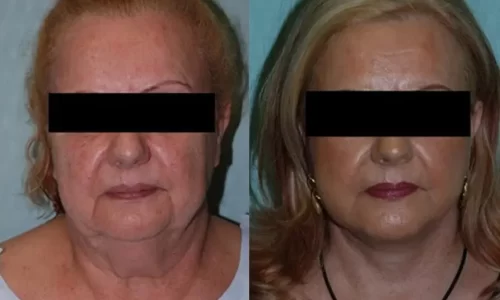 Facelift Before & After