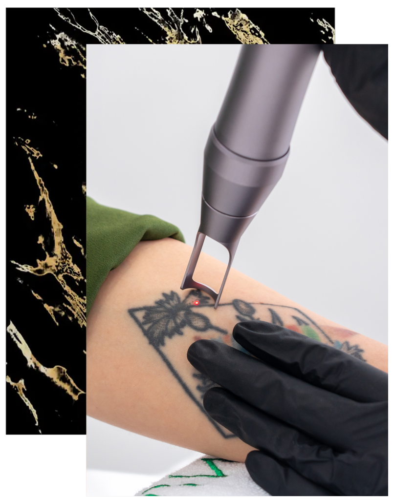 Laser tattoo removal device treating a black ink tattoo on a patient's arm at Finesse Cosmetic Surgery