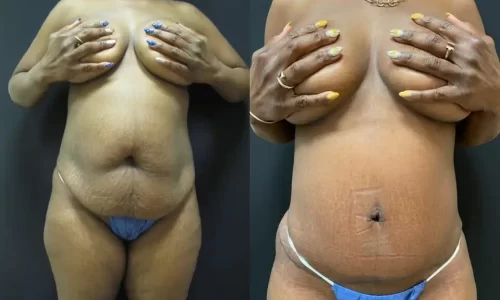 Before and after image of female abdominoplasty