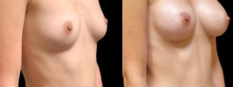 Breast Augmentation, Female 25-30yo, White, Silicone 195cc Left, 210cc Right