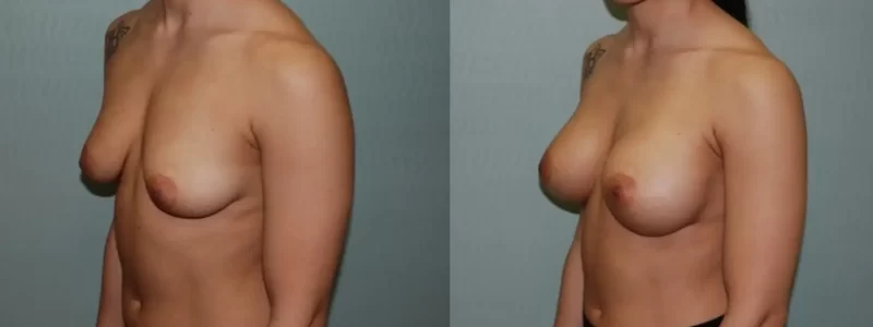 Breast augmentation before and after results