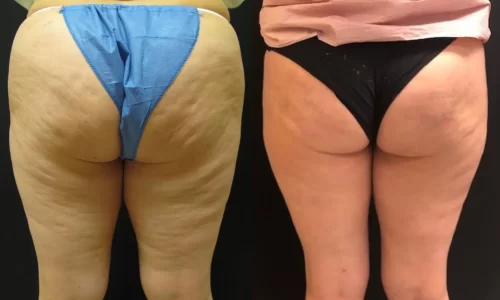 Cellulaze before and after results