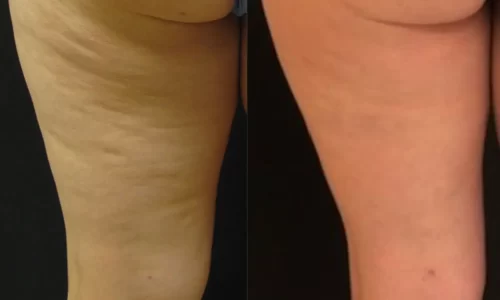 Cellulaze before and after results