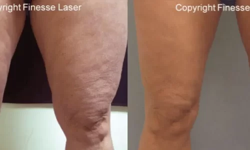 Cellulaze patient before & after results.