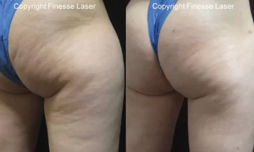 Cellulaze patient before & after results.