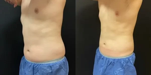 Coolsculpting before and after results