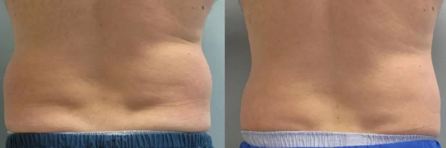 Coolsculpting before and after results