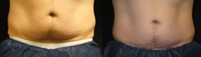 Coolsculpting before and after results